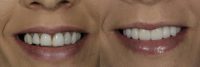 35-44 year old woman treated with Smile Makeover