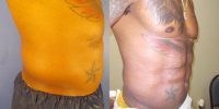 35-44 year old man treated with BodyTite