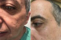 35-44 year old man treated with Wrinkle Treatment