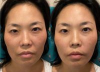 35-44 year old woman treated with Liquid Facelift