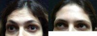 35-44 year old woman treated with Botox on forehead
