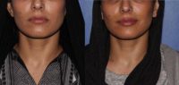 35-44 year old woman treated with Restylane Defyne