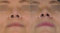 45-54 year old woman treated with Asian Rhinoplasty and Alar Base Narrowing