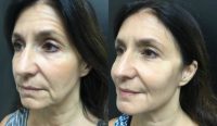 45-54 year old woman treated with Nonsurgical Facelift