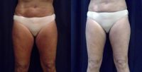 45-54 year old woman treated with CoolSculpting