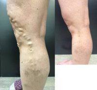 45-54 year old woman treated with Varithena