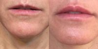 45-54 year old woman treated with Juvederm for Lip Augmentation