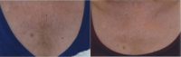 45-54 year old woman treated with Skin Tightening