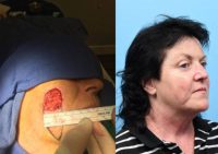 45-54 year old woman treated with Facial Reconstructive Surgery