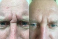 45-54 year old man treated with Botox
