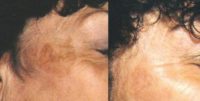 45-54 year old Female treatment with Nd/Yag Laser