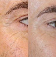 45-54 year old man treated with Fillers for Crows Feet Lines