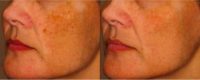 45-54 year old woman treated with Yag Laser for Melasma