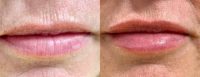 45-54 year old woman treated with Lip Augmentation