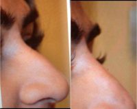 5 Minute Nose Job using Dermal Filler Juvederm Ultraplus