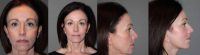 50 Year Old Female Cosmetic Facelift