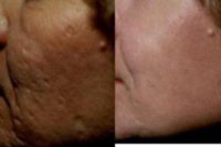 45-54 year old woman treated with CO2 Laser for acne scars