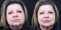 50 year old female treated with Injectable Fillers