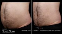 45-54 year old man treated with SculpSure