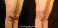 45-54 year old woman treated with Laser Liposuction