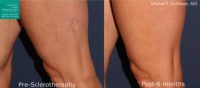 45-54 year old woman treated with Sclerotherapy
