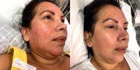 45-54 year old woman treated with Laser Peel
