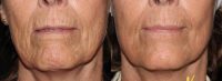 45-54 year old woman treated with Microneedling RF
