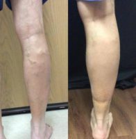 45-54 year old man treated with Vein Treatment