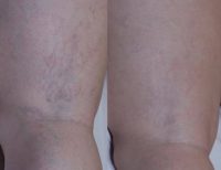 45-54 year old woman treated with Laser Hair Removal