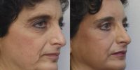 45-54 year old woman treated with Laser Resurfacing and Upper Eyelid Blepharoplasty