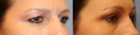 45-54 year old woman treated with Endoscopic Brow Lift, Eyelid Surgery and Laser