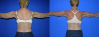45-54 year old woman treated with Smart Lipo