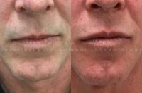 45-54 year old man treated with Restylane Silk