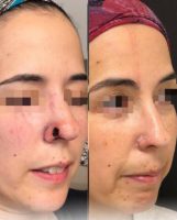 45-54 year old woman treated with Mohs Surgery