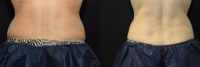45-54 year old woman  R & L Flank and hips treated with CoolSculpting