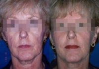 55 year old woman treated with subcision for acne scars