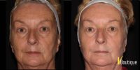 55-64 year old woman treated with Fractional Laser