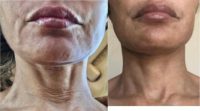 55-64 year old woman treated with Wrinkle Treatment