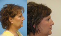 56 year old female facial rejuvenation