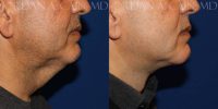 55-64 year old man treated with Direct Neck Lift