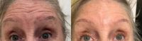 55-64 year old woman treated with Botox to the Forehead