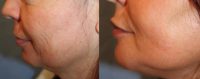 55-64 year old woman treated with Chin Surgery