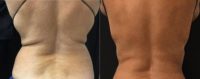 55-64 year old woman treated with CoolSculpting