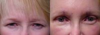 55-64 year old woman treated with Eyebrow Lift