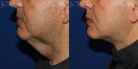 55-64 year old man treated with Direct Neck Lift