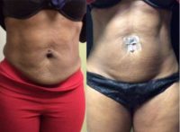 55-64 year old woman treated with SculpSure