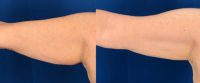 55-64 year old woman treated with CoolSculpting for Arms