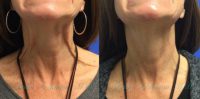 55-64 year old woman treated with Botox for neck lines