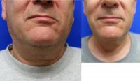 55-64 year old man treated with Kybella