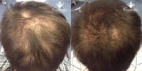 55-64 year old woman treated with PRP for Hair Loss